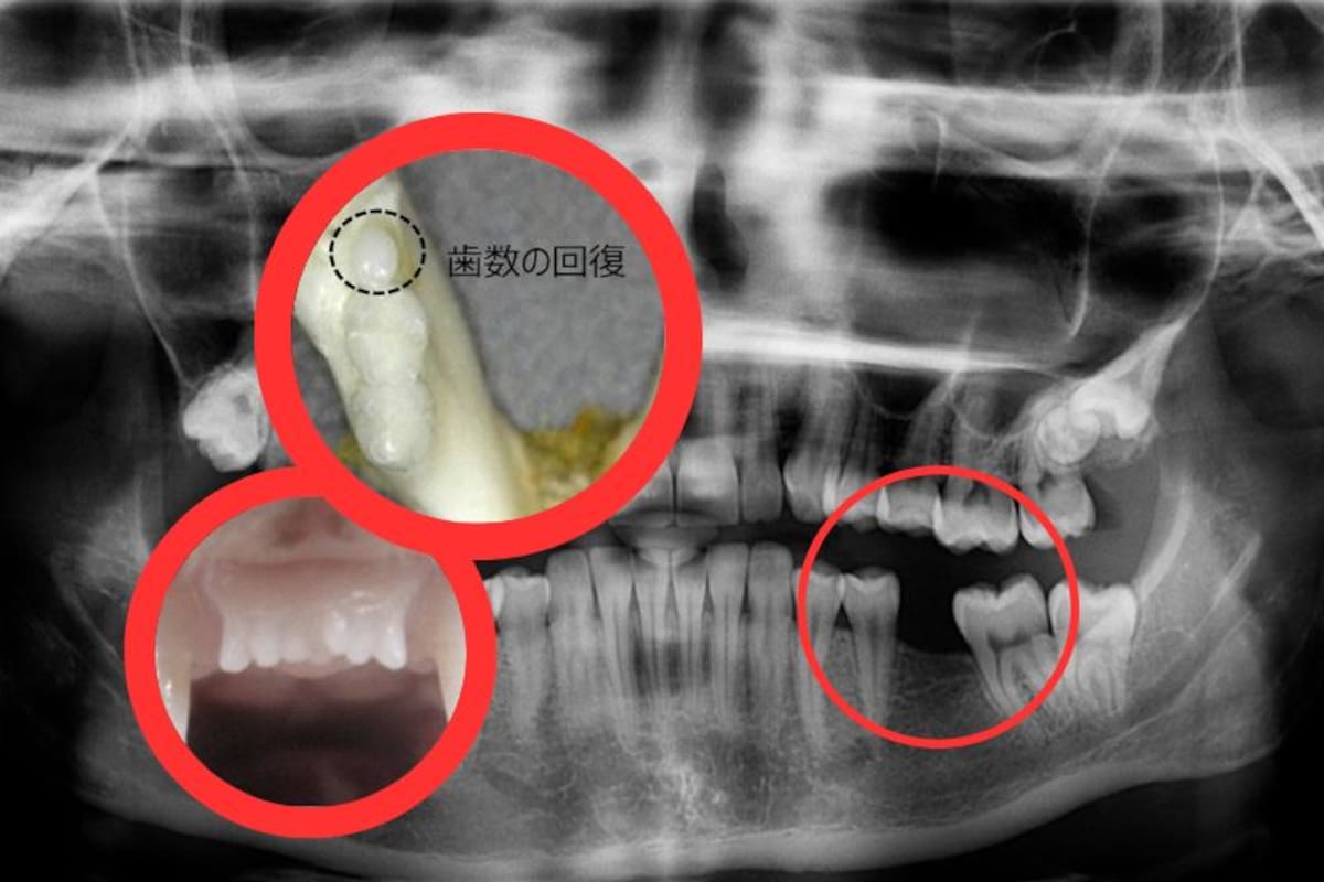 ¿Adiós a las dentaduras? Japón prueba medicamento para regenerar dientes