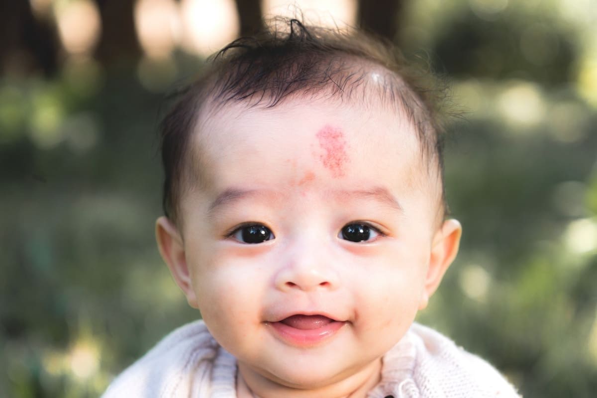 ¿Qué significa la mancha roja en el rostro de un bebé y cuándo debe revisarla un médico?