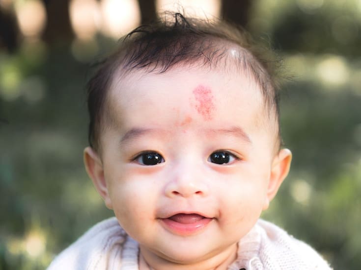 ¿Qué significa la mancha roja en el rostro de un bebé y cuándo debe revisarla un médico?