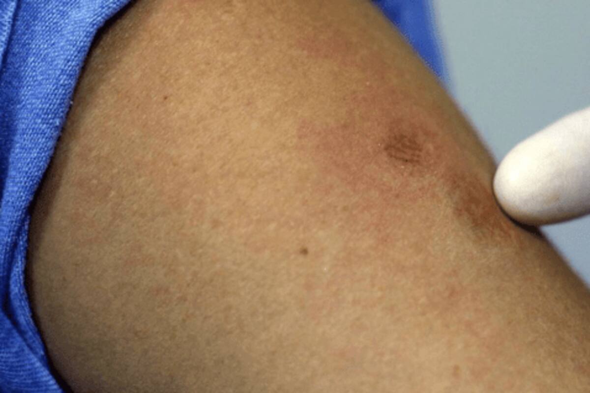 Viruela del mono: Van 49 casos confirmados en Yucatán