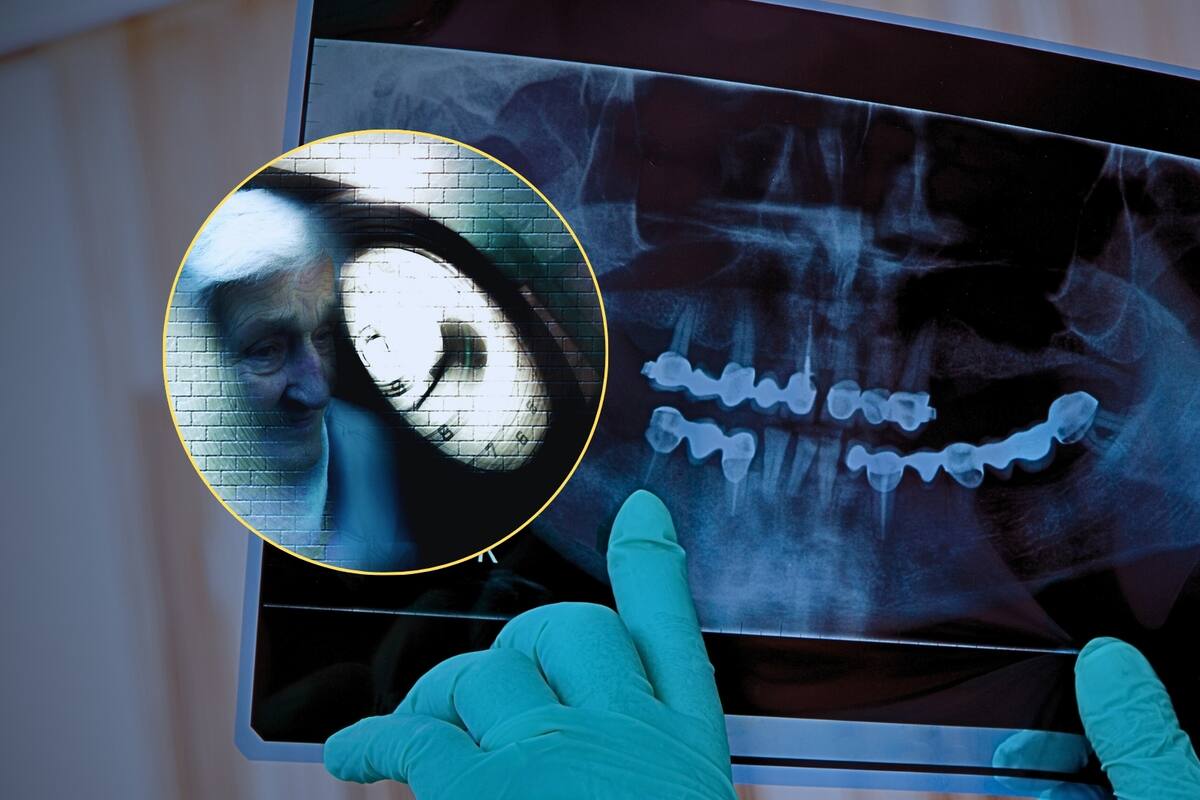 El Alzheimer podría venir de bacterias en tu boca, según estudio