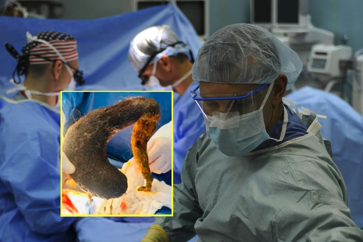 Descubren y extraen una gigante bola de pelo del estómago de una joven en Ecuador