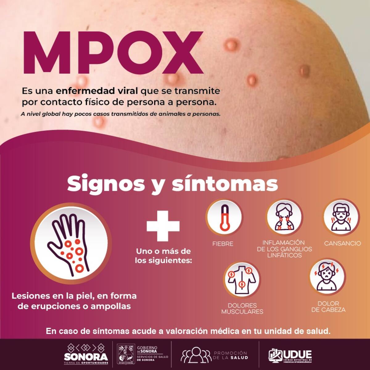 Vigilancia Epidemiológica en Sonora Ante la Amenaza de MPOX
