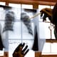 Reducen casos y muertes por tuberculosis en Baja California con pruebas moleculares