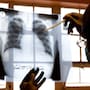 Reducen casos y muertes por tuberculosis en Baja California con pruebas moleculares