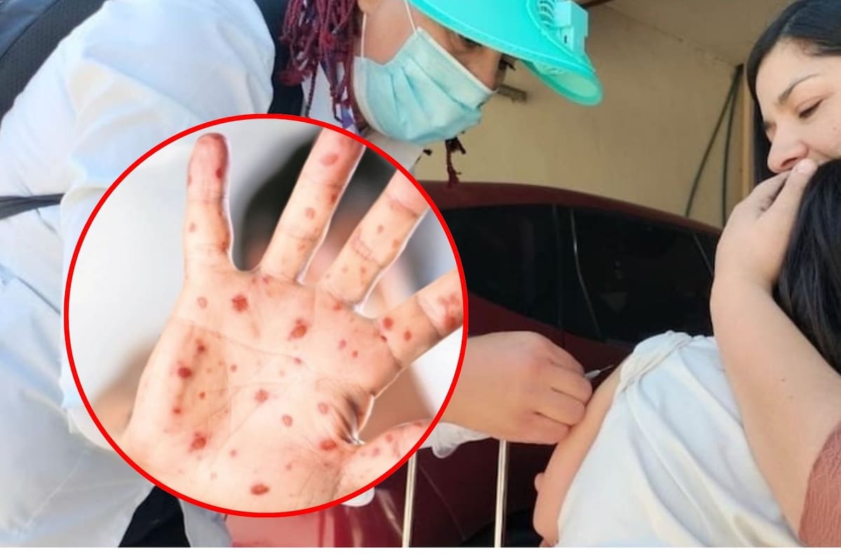 Especialistas advierten que el sarampión resurge en México tras el rezago de vacunación por el covid-19
