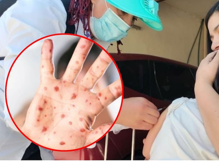 Especialistas advierten que el sarampión resurge en México tras el rezago de vacunación por el covid-19