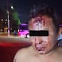 Golpea a su pareja y vecino lo deja severamente lesionado al defenderla
