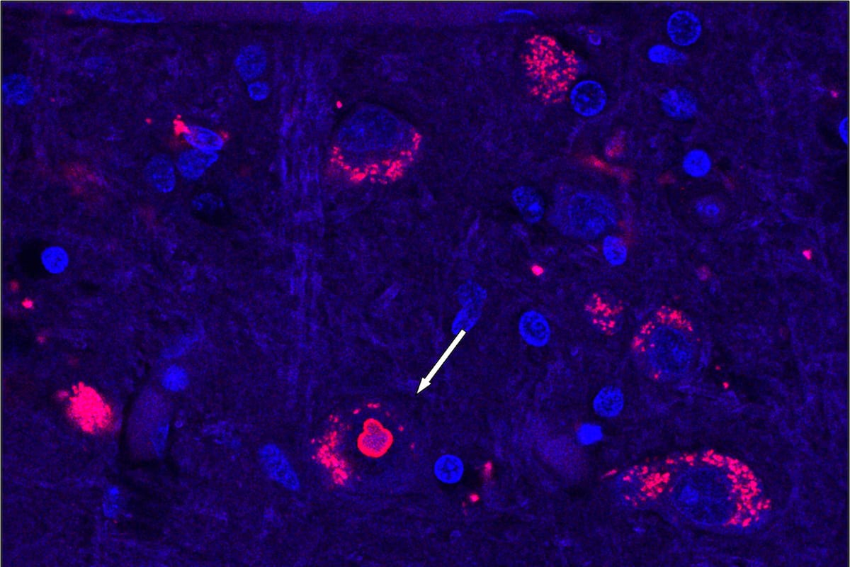 Descubren causa de enfermedad genética rara, es clave para futuras terapias