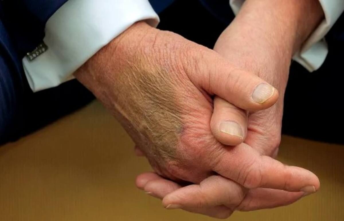 Esta explicación busca despejar cualquier especulación sobre el origen de la lesión, subrayando la dedicación del presidente a su labor y su contacto directo con la ciudadanía.   Foto: Redes.