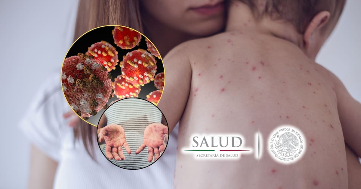 Alerta de sarampión en México: conoce los estados con más casos y los grupos más vulnerables
