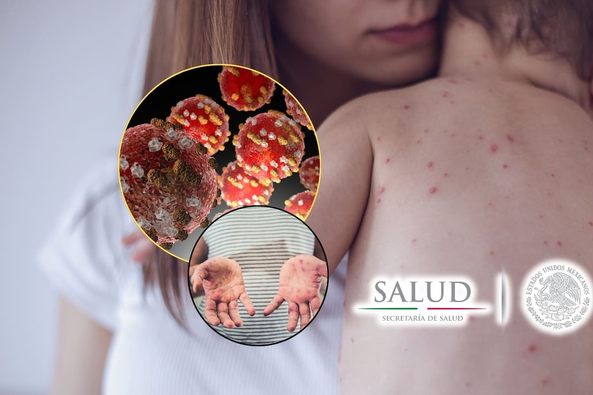 Secretaría de Salud alerta por casos de sarampión en México: ¿Qué estados tienen más casos y quiénes son los más afectados?