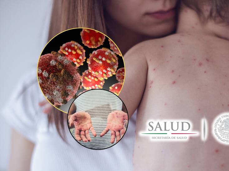 Sarampión continúa al alza en México: Confirman 78 nuevos casos en una semana; Chihuahua concentra la mayoría de los contagios
