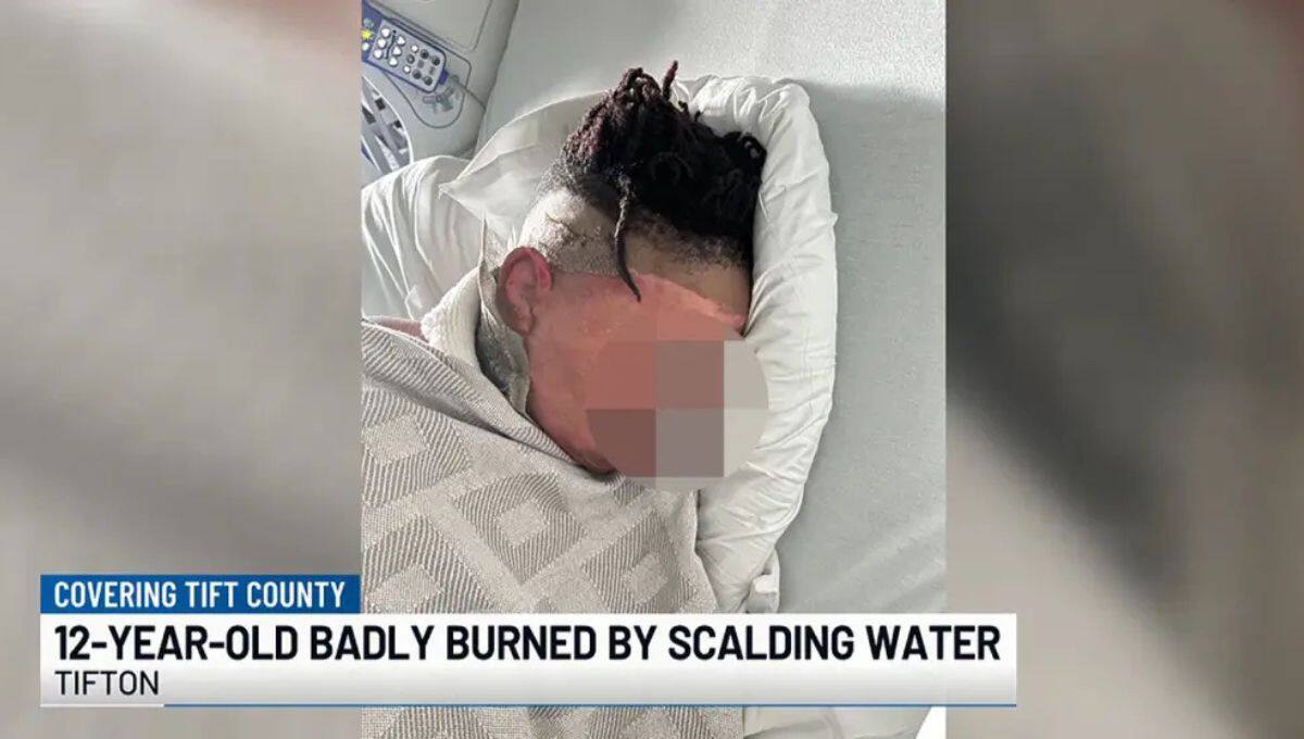 Niño de 12 años sufre quemaduras graves