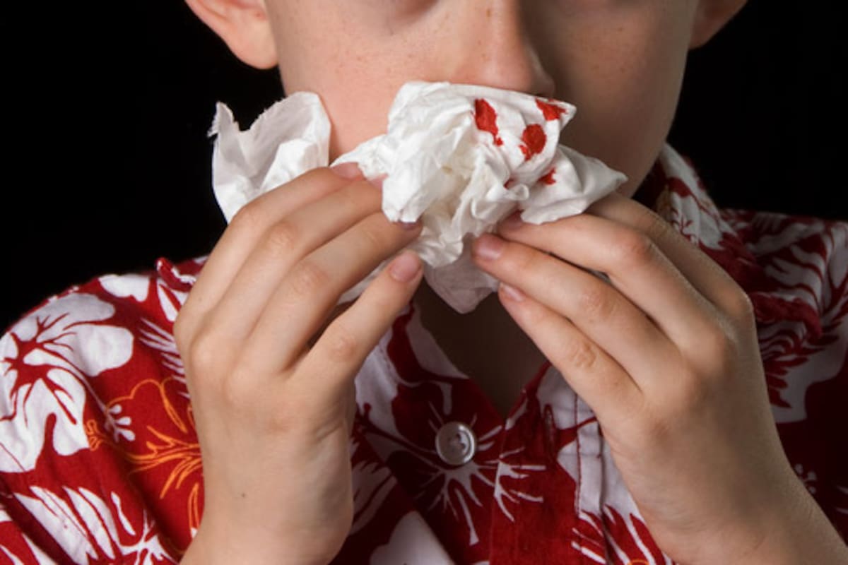 IMSS aclara que fisuras nasales pueden pasar desapercibidas en primeras revisiones médicas