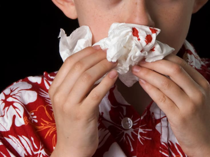 IMSS aclara que fisuras nasales pueden pasar desapercibidas en primeras revisiones médicas