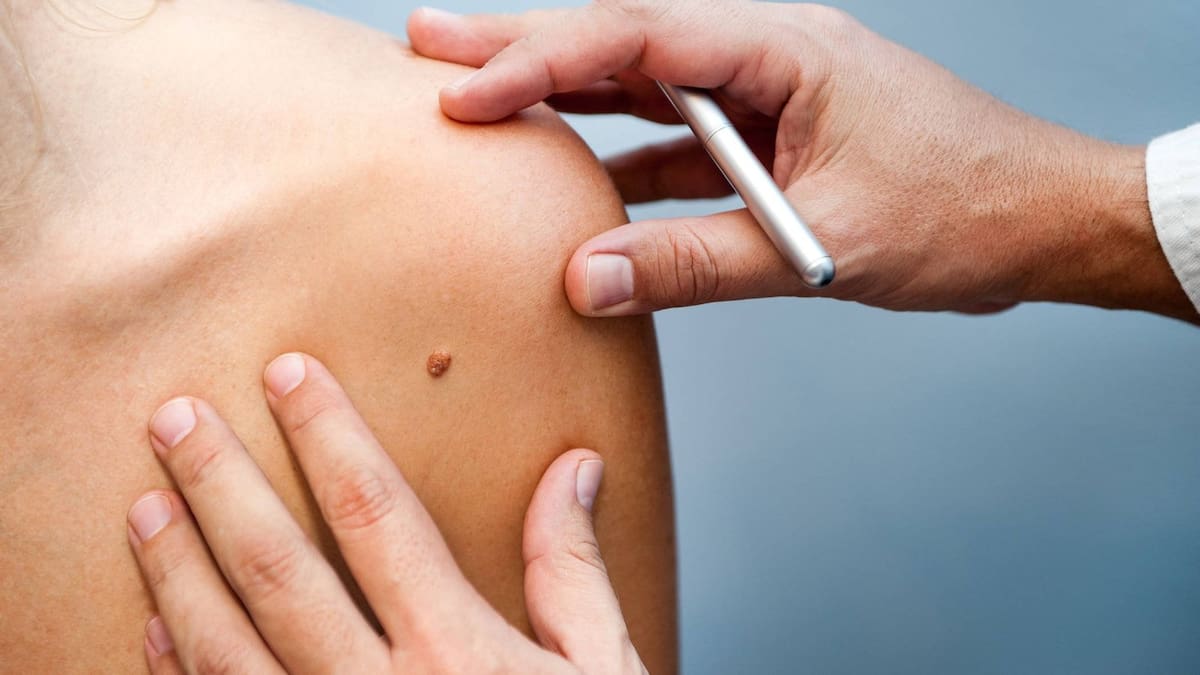 Hoy, 13 de junio, es el Día Mundial del Cáncer de Piel. Foto: Colegio Médico