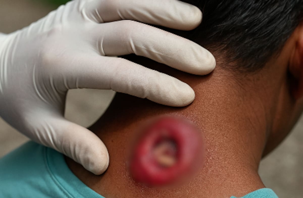 Imagen ilustrativa censurada de miasis en humanos. / Creada con IA (Chatgpt).