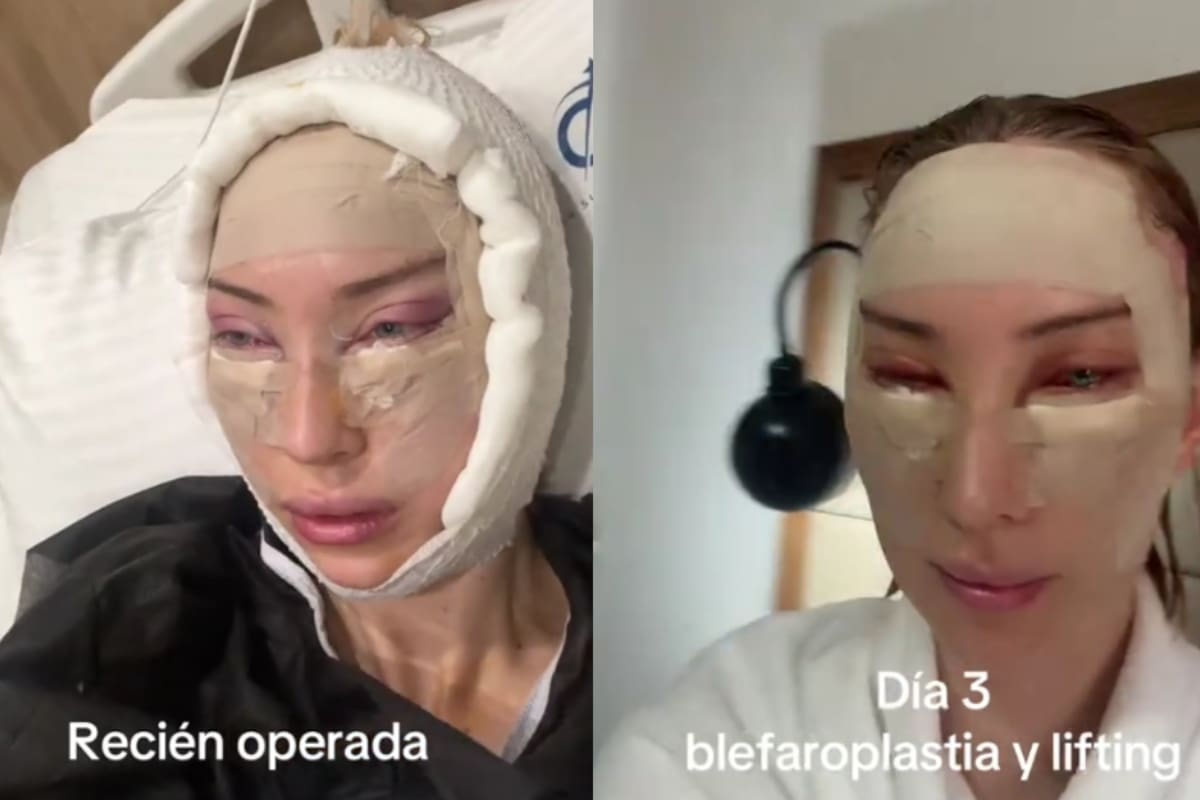 Mujer muestra su proceso de blefaroplastia y lifting, desde el quirófano hasta el postoperatorio, y causa impresión en redes sociales