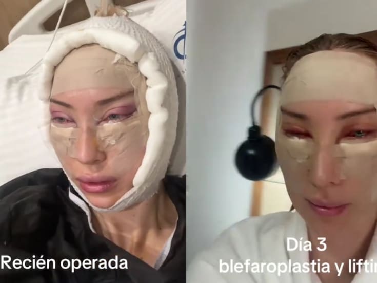Mujer muestra su proceso de blefaroplastia y lifting, desde el quirófano hasta el postoperatorio, y causa impresión en redes sociales