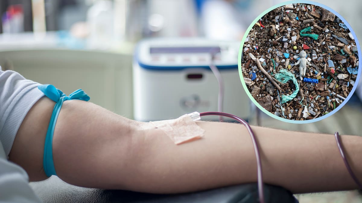 Científicos investigan si la aféresis terapéutica, una técnica médica que filtra la sangre, puede ayudar a eliminar microplásticos del cuerpo humano/Foto: Canva