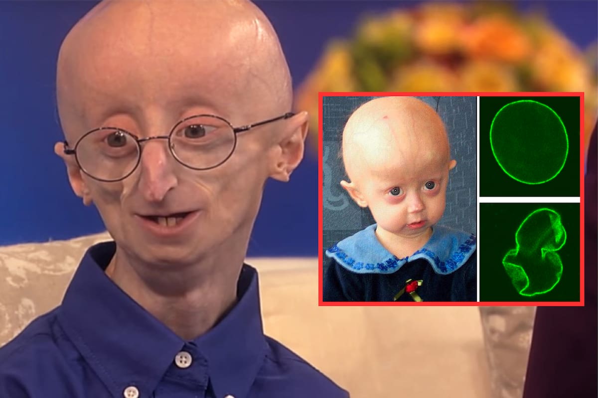 ¿Qué es la progeria? La enfermedad que te hace envejecer más rápido