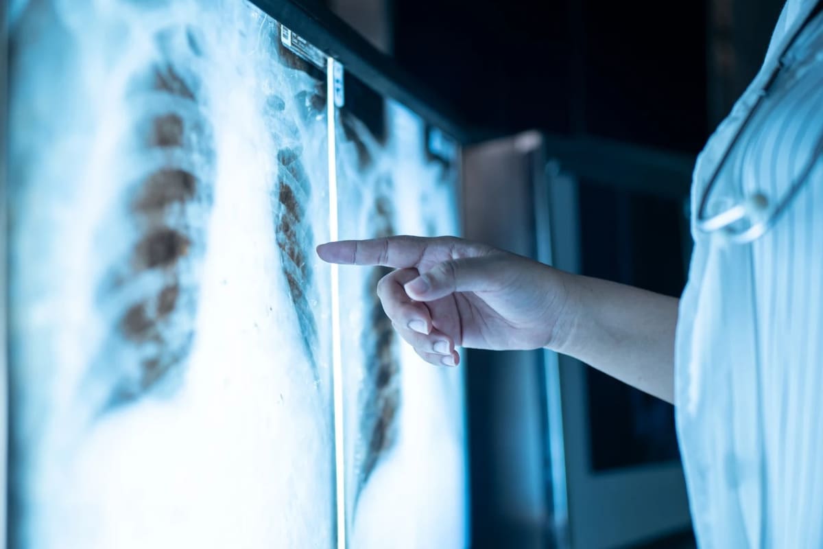 Cáncer de pulmón en México: Crecen casos en jóvenes y en no fumadores, pero hay avances prometedores en tratamiento, según expertos
