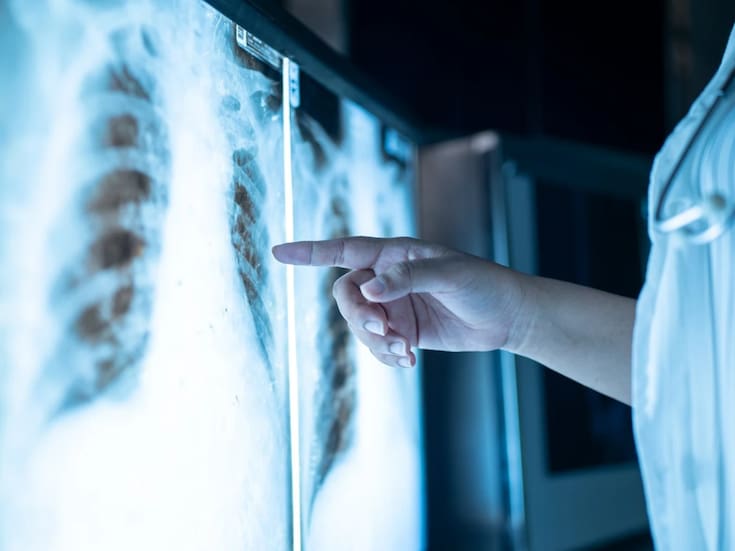 Cáncer de pulmón en México: Crecen casos en jóvenes y en no fumadores, pero hay avances prometedores en tratamiento, según expertos