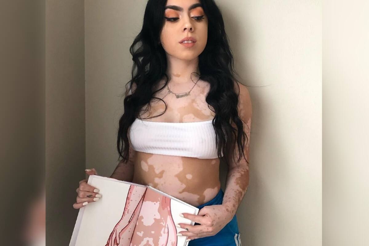 Enfrenta vitiligo y lo convierte en arte corporal