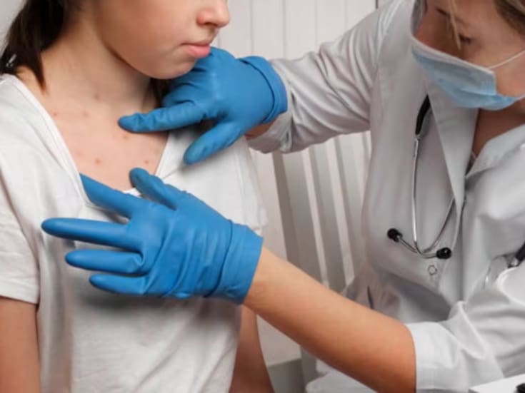 Detectan cuatro casos de varicela en la Secundaria General No. 76 y suspenden clases por una semana