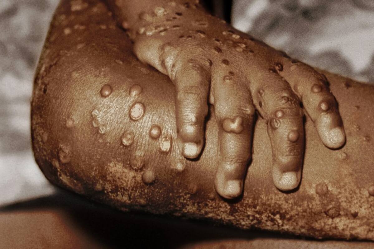 Viruela del mono: qué es esta enfermedad detectada en Europa y Norteamérica y qué riesgos entraña para la salud