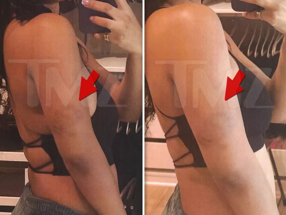 Halle compartió fotografías de sus lesiones a manera de evidencia del ataque | Foto: TMZ.