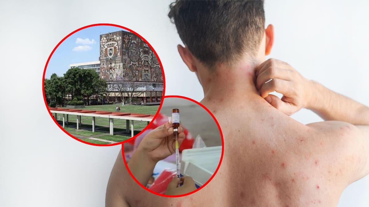 UNAM detecta caso sospechoso de sarampión en la Facultad de Medicina, activa protocolos de vigilancia epidemiológica y refuerza acciones preventivas con apoyo del IMSS