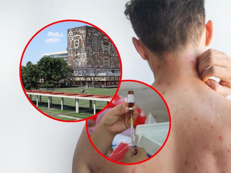 UNAM detecta caso sospechoso de sarampión en la Facultad de Medicina, activa protocolos de vigilancia epidemiológica y refuerza acciones preventivas con apoyo del IMSS