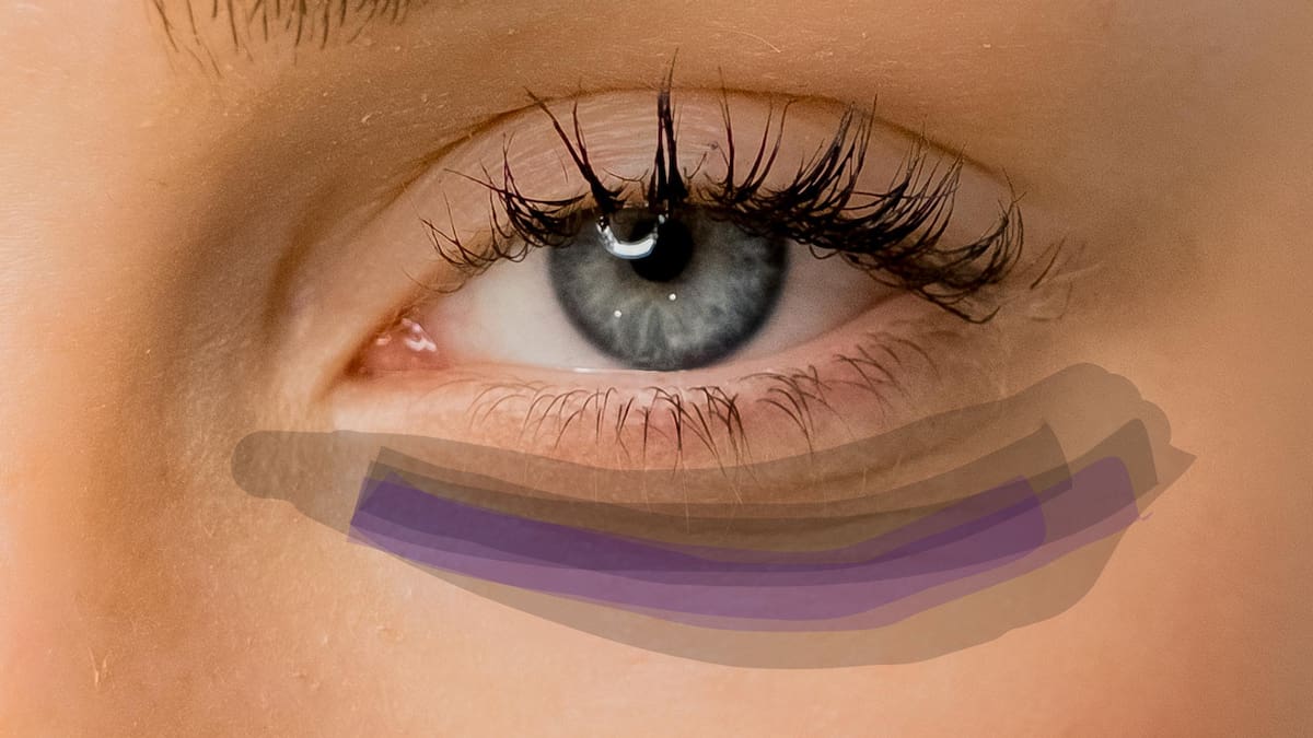 Las ojeras, esas sombras en el contorno de los ojos, son un problema estético que afecta la apariencia y la autoestima, sin representar un riesgo para la salud/Foto: Canva