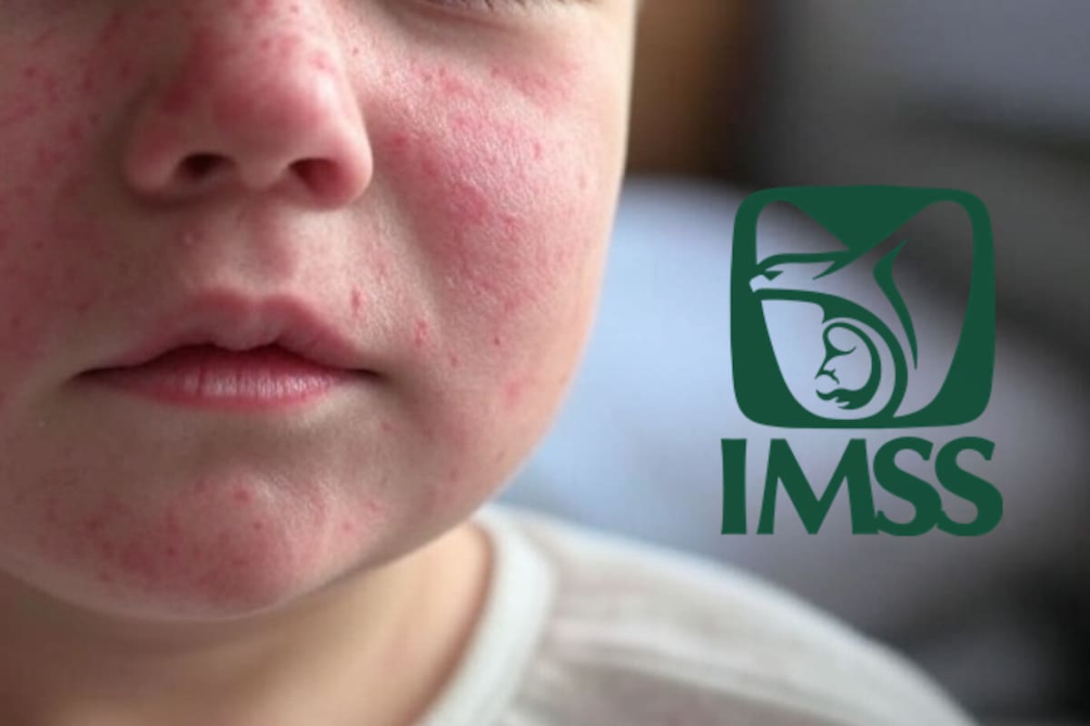 Crece interés por informarse del sarampión: IMSS Sonora