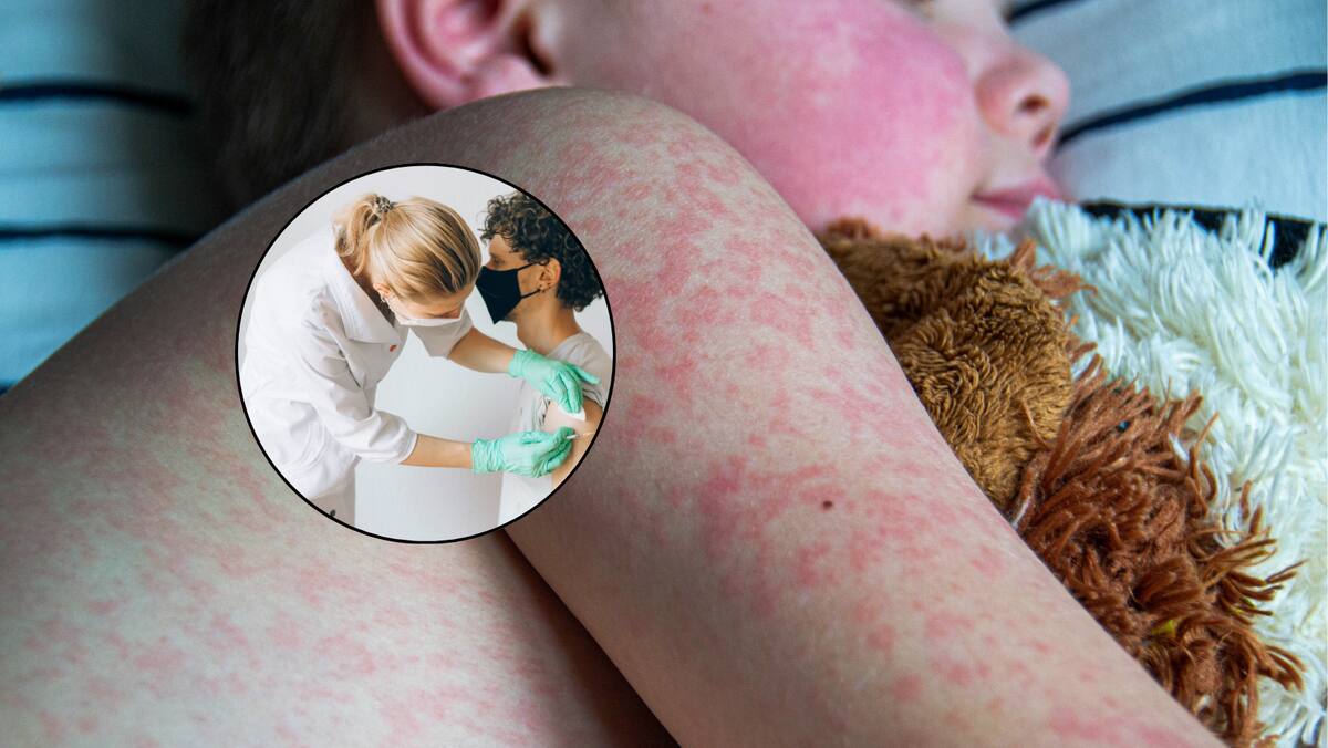 La guía de los CDC especifica que todas las personas a partir del año de edad deben contar con dos dosis de la vacuna triple viral (sarampión, paperas y rubéola).