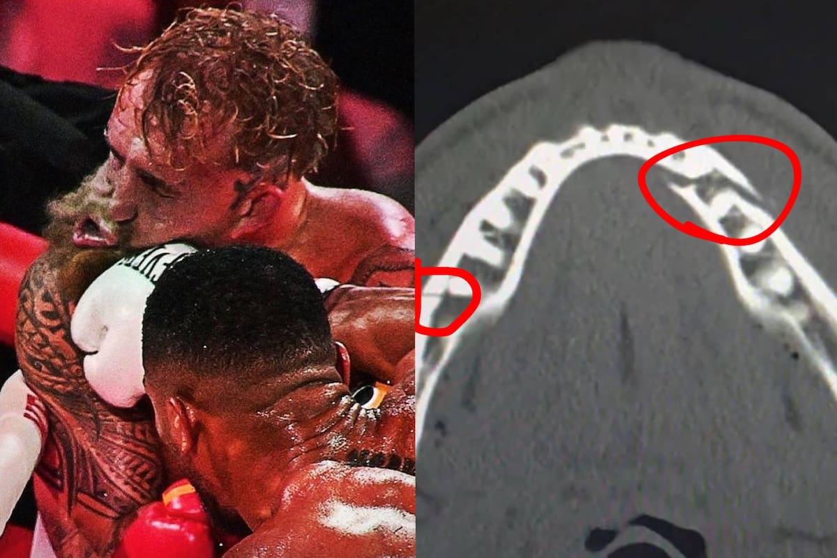 Jake Paul sufre doble fractura de mandíbula tras brutal nocaut de Anthony Joshua