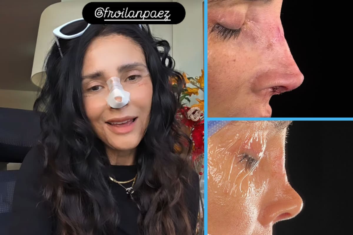 Dorismar, conductora de Televisa desfigurada por cirugías, ahora presume nueva nariz tras reconstrucción: “Estoy muy feliz” (VIDEO)