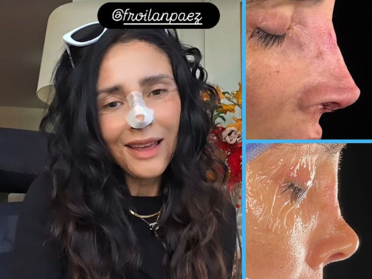 Dorismar, conductora de Televisa desfigurada por cirugías, ahora presume nueva nariz tras reconstrucción: “Estoy muy feliz” (VIDEO)