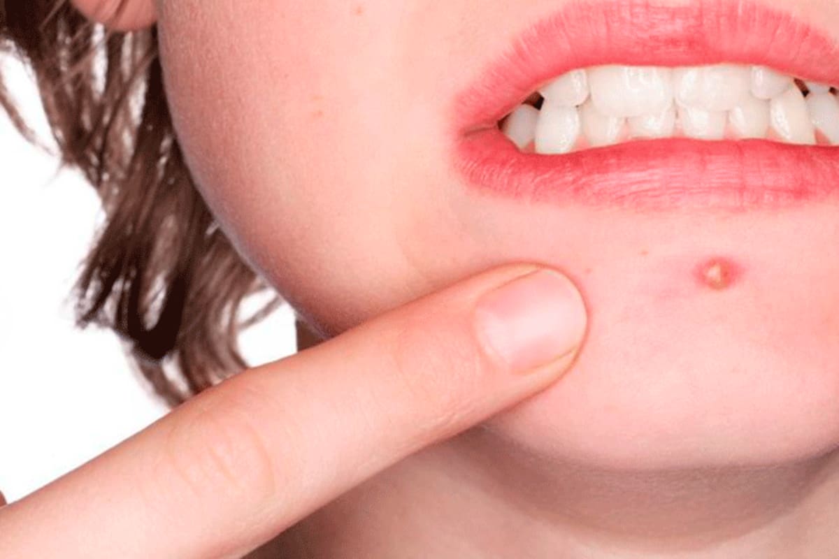 ¿Cómo bajar la hinchazón de los granos?