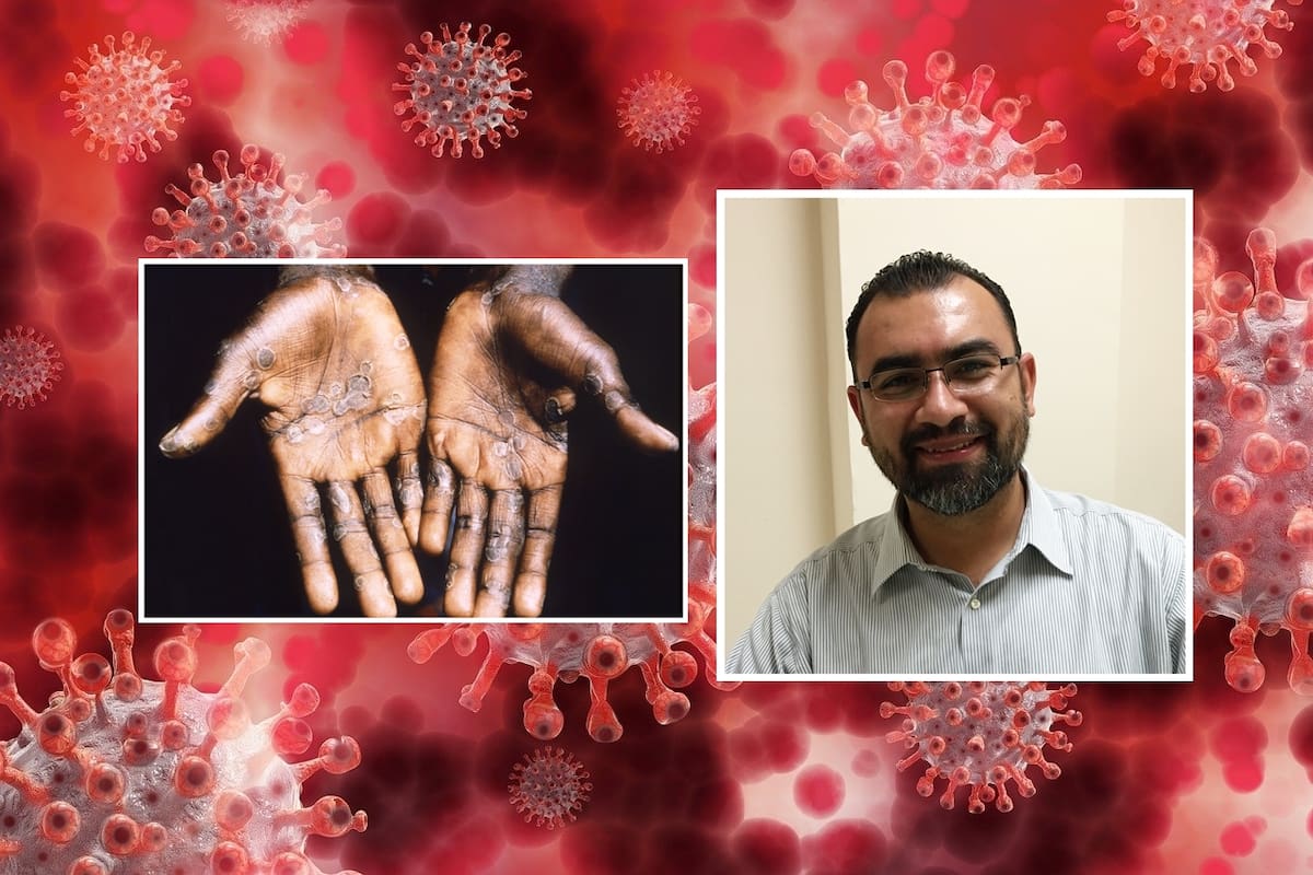 Casos de Mpox detectados en Sonora no deben ser motivo de preocupación: Médico