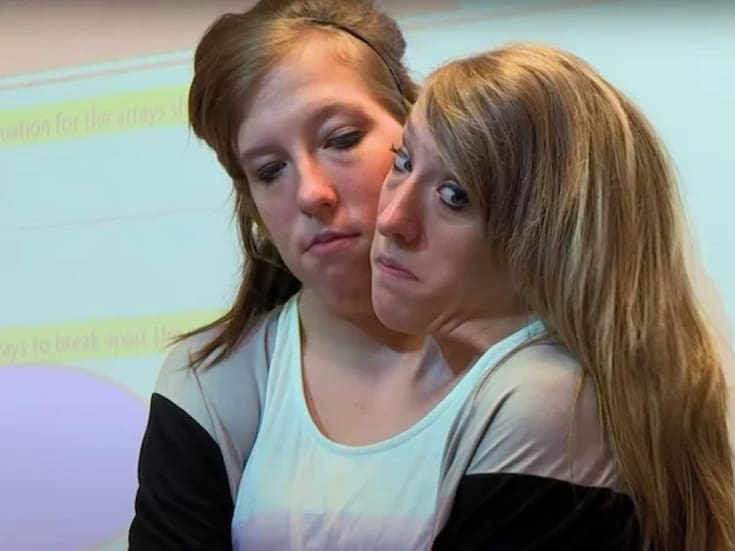 Abby y Brittany Hensel: la vida actual de las gemelas unidas que crecieron frente a las cámaras