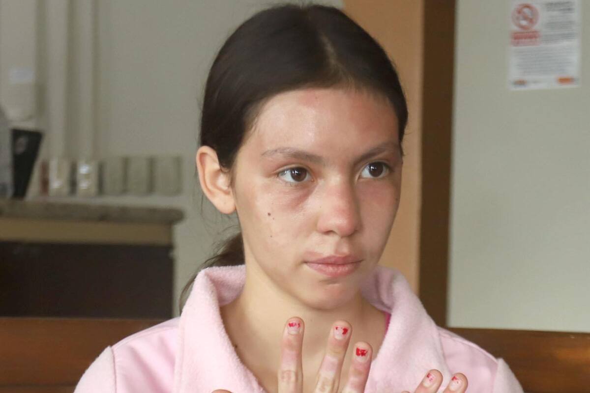 "¿Por qué a mí?": Claritza, menor lesionada en explosión de transformador