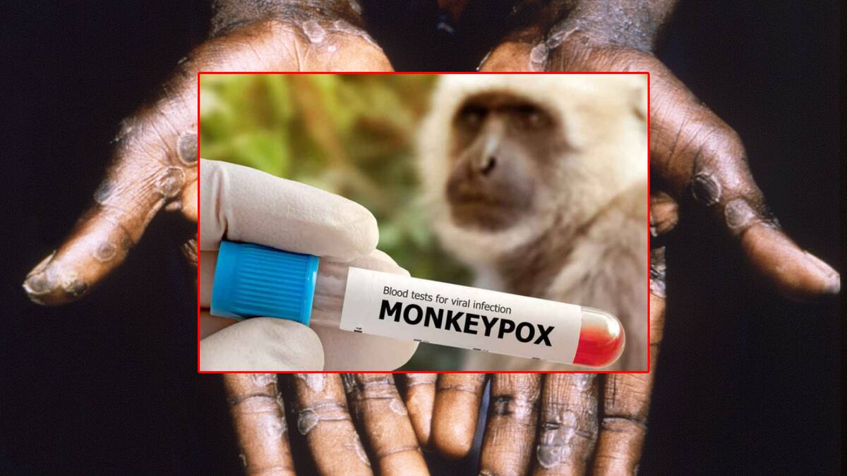 El virus mpox, antes llamado viruela del mono, podría ser declarado emergencia sanitaria internacional; OMS lo decidirá el miércoles.