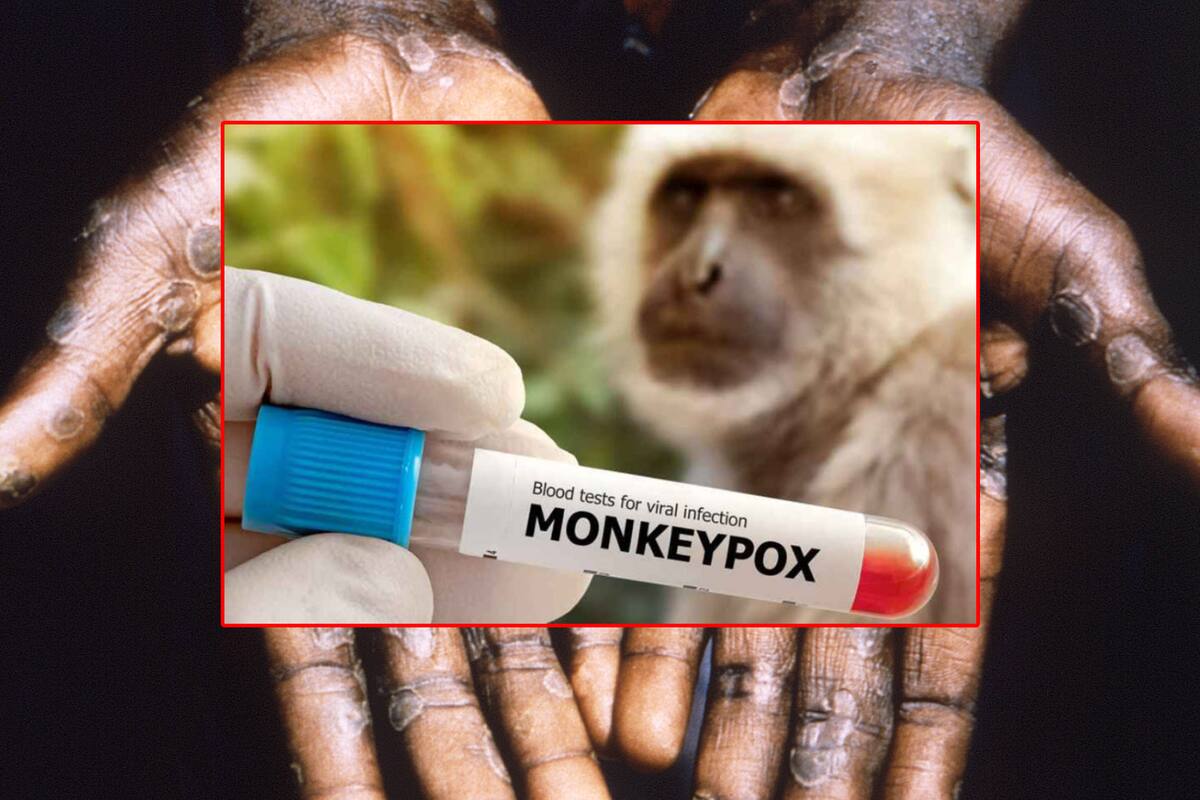 OMS decidirá si Mpox es emergencia mundial, ¿Cuándo y qué consideraría?