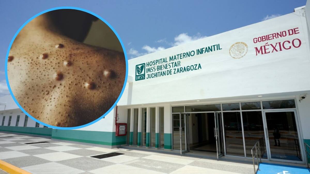 La Secretaría de Salud confirmó hasta inicios de agosto 49 casos por mpox (viruela del mono) en México.