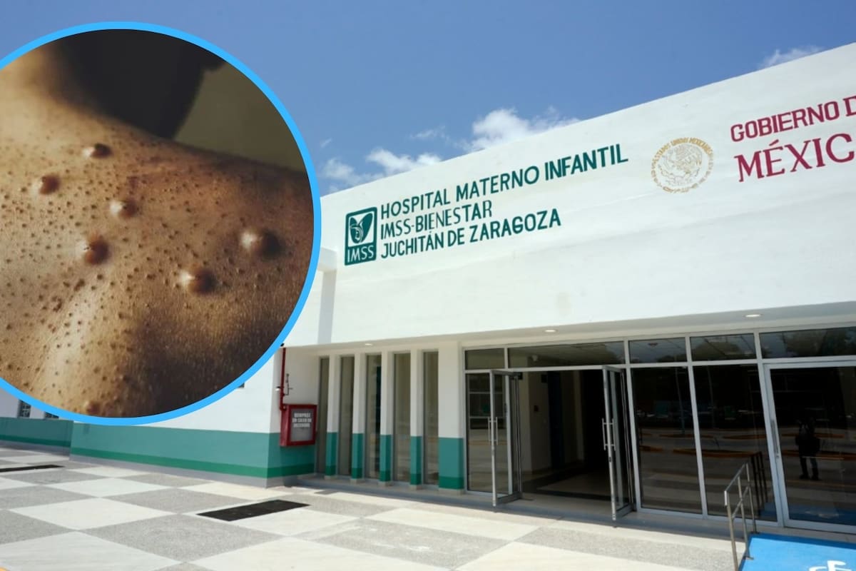 Esto dice IMSS-Bienestar acerca de los crecientes casos de Mpox ¿Qué hay que hacer?