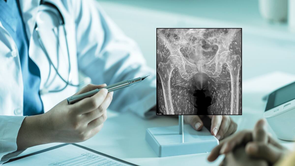 Hombre fue al doctor por una fractura, pero los médicos descubrieron que su cuerpo estaba lleno de larvas: ¿Qué son estos parásitos, los cuales son más comunes de lo que se cree?