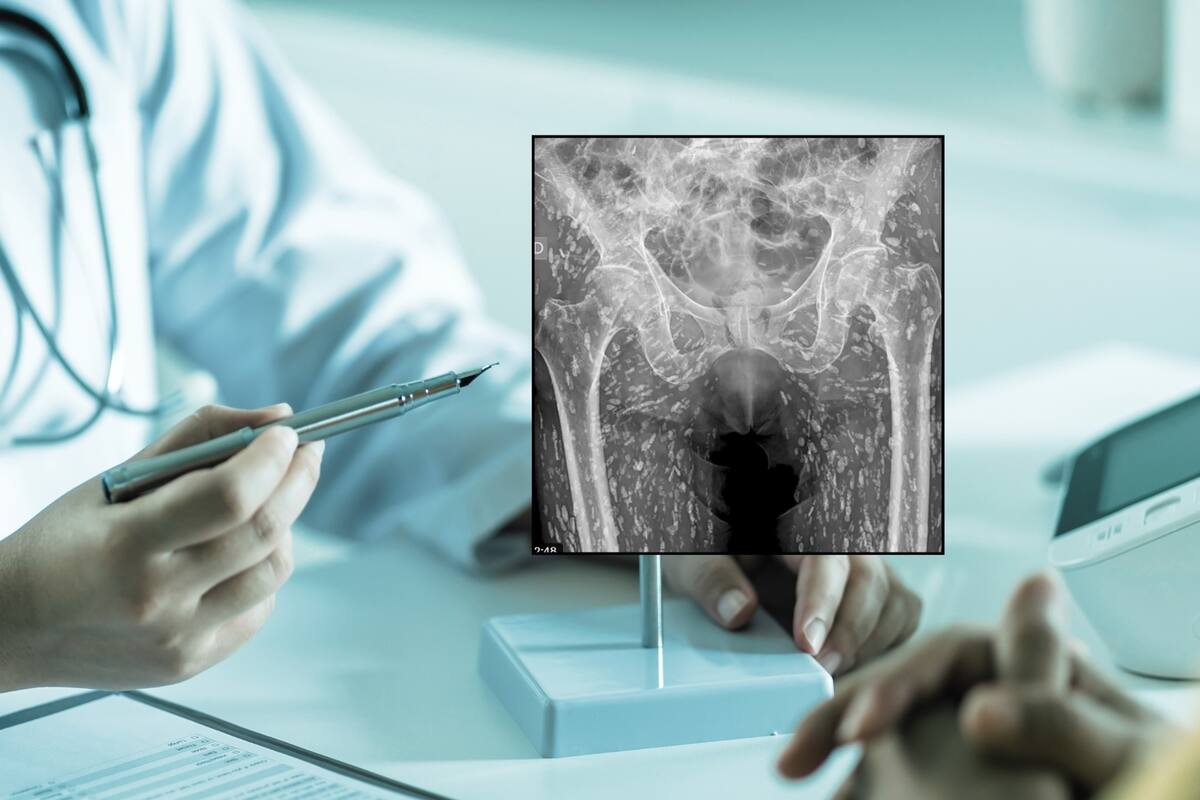 Hombre fue al doctor por una fractura, pero los médicos descubrieron que su cuerpo estaba lleno de larvas: ¿Qué son estos parásitos, los cuales son más comunes de lo que se cree?